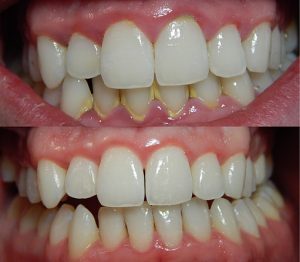 Antes y después de una periodoncia