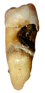 Imagen de un premolar afectado de caries dental