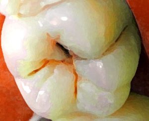 Imagen de un molar afectado de caries dental