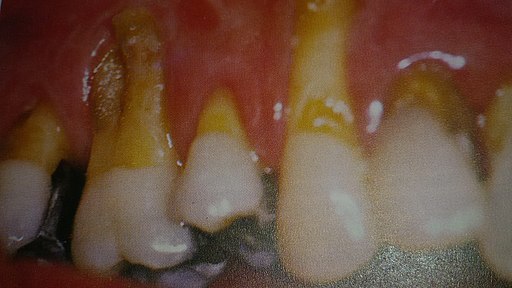 Paciente que padece una periodontitis