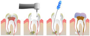 Realización de una endodoncia