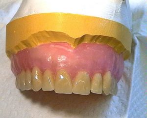 Prótesis dentales completas removibles
