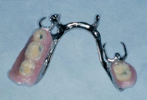Prótesis dentales removibles metálicas