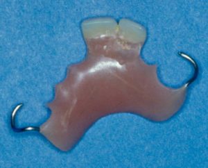 Prótesis dentales metálicas