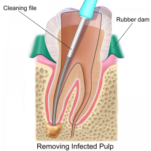 Técnica de la endodoncia