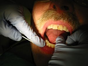 Limpieza dental mediante hilo dental