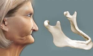Imagen del envejecimiento causado por la perdida de masa ósea al no utilizar implantes dentales