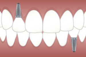 Imagen de implantes dentales