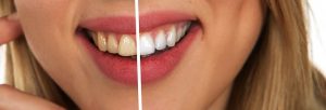 Antes y despues de haber aplicado un tratamiento de odontología estética
