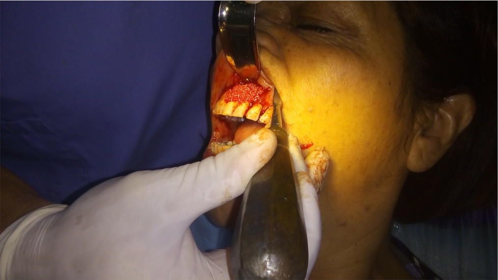 Paciente con periodontitis