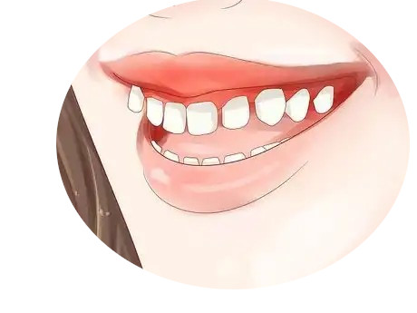 Dientes desalineados