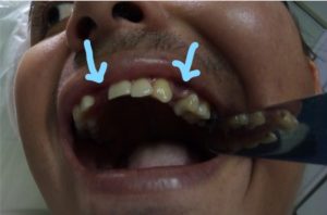 Prótesis dental removible