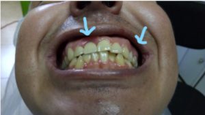 Protesis dental removible