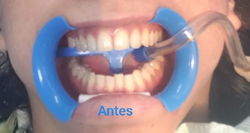 Blanqueamiento dental. Antes