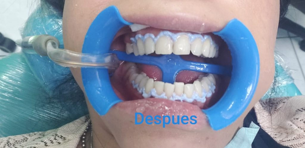 Blanqueamiento dental. Después del tratamiento