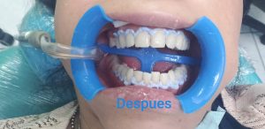 Blanqueamiento dental. Después del tratamiento