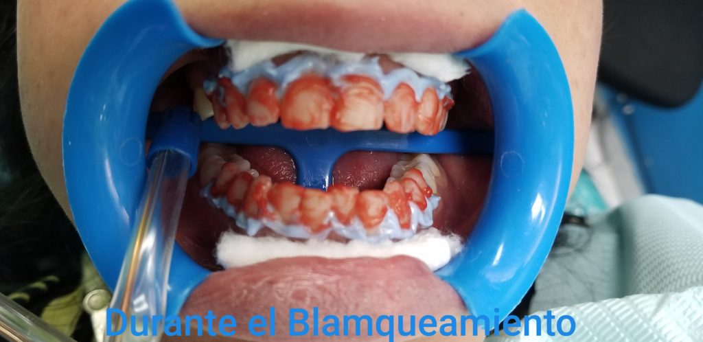 Blanqueamiento dental. Durante la aplicación del tratamiento