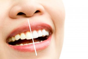 Resultado del tratamiento del oscurecimiento de los dientes