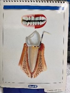 Periodontitis inicial