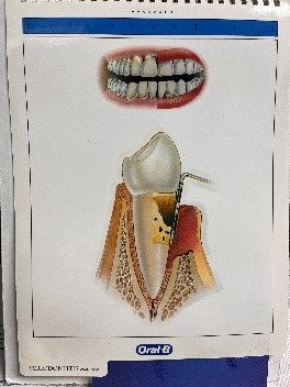 Periodontitis avanzada
