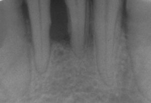 Imagen periodontitis