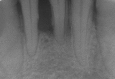 Imagen periodontitis